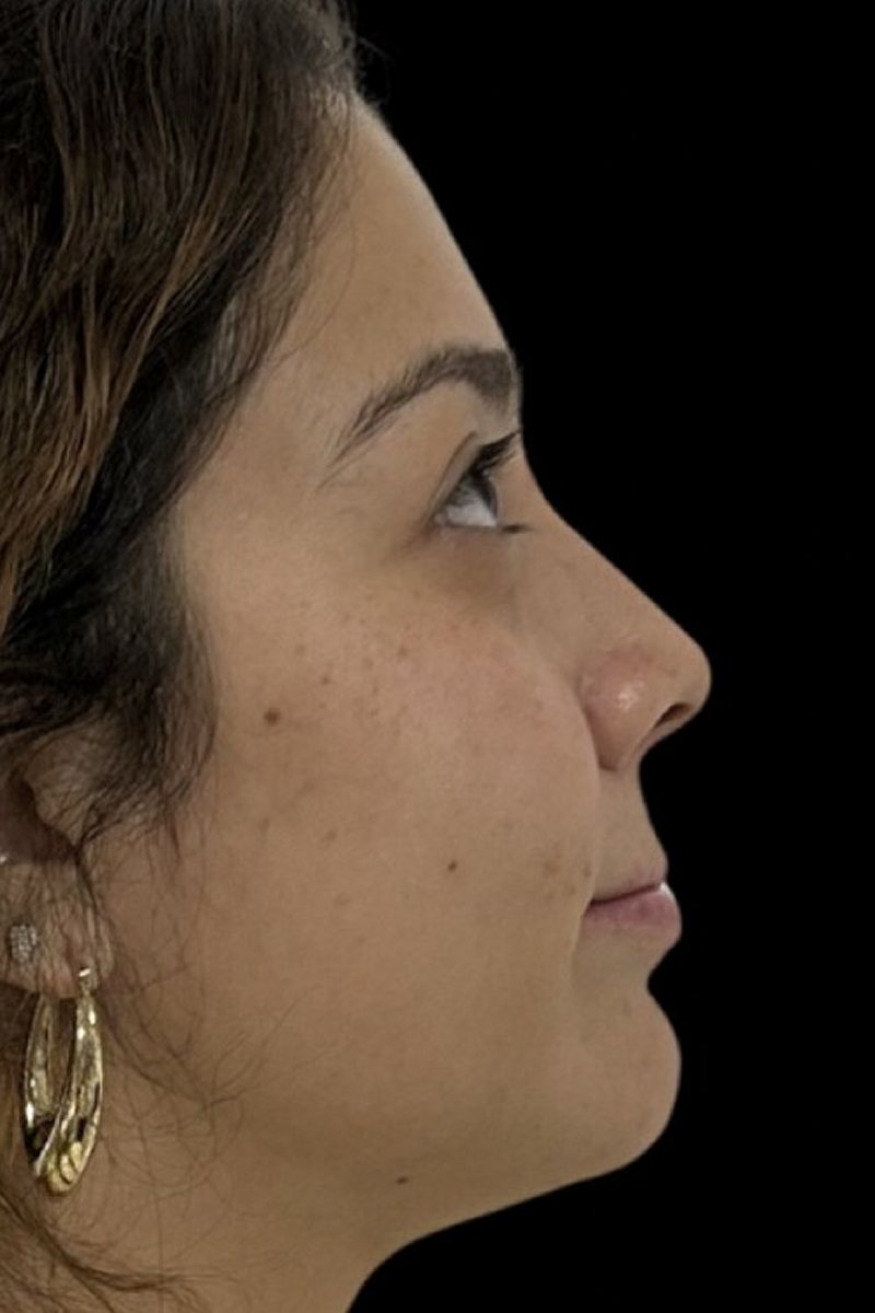 Caso 4, perfil: antes