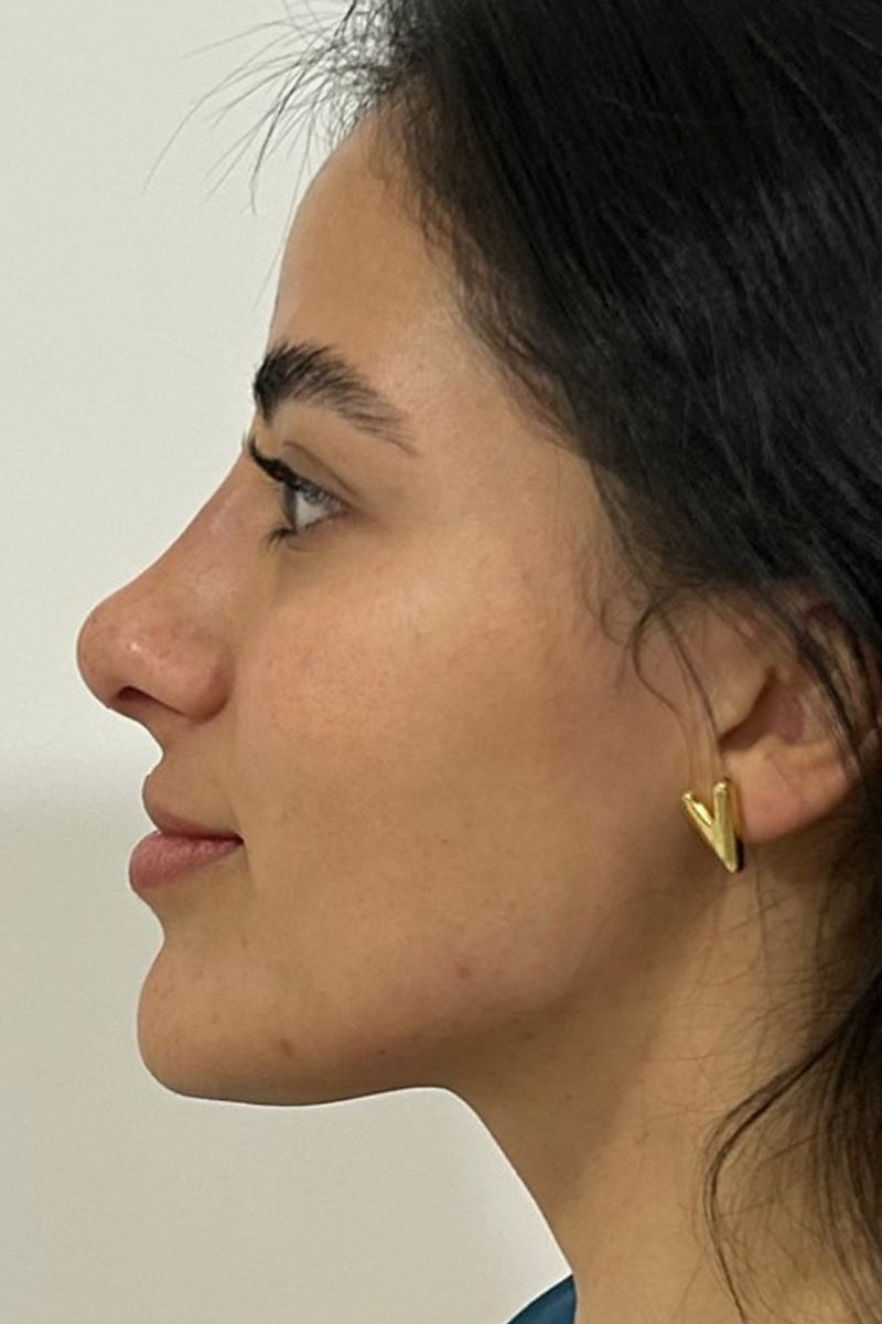 Caso 5, perfil: depois